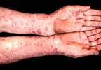 Secukinumab Efficacy in TNFi-Naïve & Exposed PsA Patients Compared Secukinumab Efficacy in TNFi-Naïve & Exposed PsA Patients Compared