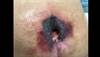 A Kennedy Terminal Ulcer in a geriatric patient A Kennedy Terminal Ulcer in a geriatric patient