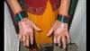 Derm Dx: Plaques, joint deformity of the hands Derm Dx: Plaques, joint deformity of the hands