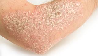 Researchers found that the annual incidence rate of PsA was 2.7 cases per 100 psoriasis patients. Researchers found that the annual incidence rate of PsA was 2.7 cases per 100 psoriasis patients.