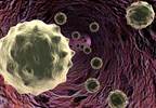 Clozapine use and neutropenia Clozapine use and neutropenia