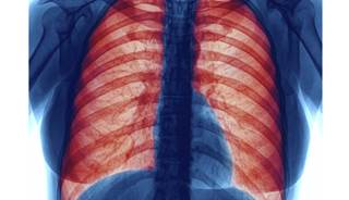 Antibiotic therapy improves outcome in acute lung function in CF. Antibiotic therapy improves outcome in acute lung function in CF.