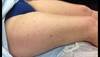 Derm Dx: An uncommon pruritic eruption Derm Dx: An uncommon pruritic eruption
