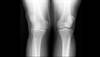 Ortho Dx: Valgus deformity of the knee Ortho Dx: Valgus deformity of the knee