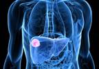 Tumor recurrence is common in patients with hepatitis C, hepatocellular carcinoma Tumor recurrence is common in patients with hepatitis C, hepatocellular carcinoma