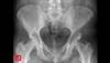 Image of the Week: Is this vanishing bone disease? Image of the Week: Is this vanishing bone disease?
