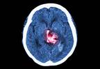 History and physical may identify patients at risk for hemorrhagic stroke History and physical may identify patients at risk for hemorrhagic stroke