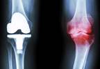Metal Sensitization After Arthroplasty More Likely for Women Metal Sensitization After Arthroplasty More Likely for Women