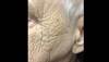 Derm Dx: Comedones on the cheeks Derm Dx: Comedones on the cheeks