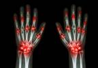 Pain complexities in rheumatoid arthritis Pain complexities in rheumatoid arthritis