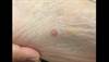 Derm Dx: An uncommon neoplasm Derm Dx: An uncommon neoplasm