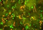 Stat consult: Lyme disease Stat consult: Lyme disease