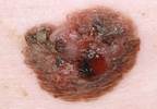 Skin cancer detection: every clinician's responsibility Skin cancer detection: every clinician's responsibility