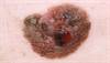 Skin cancer detection: every clinician's responsibility Skin cancer detection: every clinician's responsibility