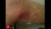 Image of the Week: When a spider bite is left untreated Image of the Week: When a spider bite is left untreated