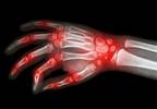 Cannabinoids may provide moderate benefit for rheumatic conditions Cannabinoids may provide moderate benefit for rheumatic conditions