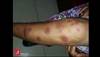 Image of the Week: An unusual rash after bathing in a stream Image of the Week: An unusual rash after bathing in a stream