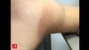 Image of the Week: Citrus exposure and phytophotodermatitis Image of the Week: Citrus exposure and phytophotodermatitis