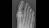 Ortho Dx: Which surgery is best for MTP joint arthritis? Ortho Dx: Which surgery is best for MTP joint arthritis?