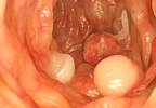 Interventions effectively increase colon cancer screening rates Interventions effectively increase colon cancer screening rates
