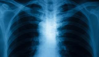 Patients with mild-to-moderate airflow limitations should be screened for COPD exacerbations. Patients with mild-to-moderate airflow limitations should be screened for COPD exacerbations.