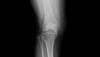 Ortho Dx: How does partial and total knee replacement compare? Ortho Dx: How does partial and total knee replacement compare?
