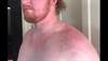 Derm Dx: A rare type of urticaria Derm Dx: A rare type of urticaria