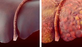 Older teen adolescents who are overweight are at an increased risk of developing liver cirrhosis later in life. Older teen adolescents who are overweight are at an increased risk of developing liver cirrhosis later in life.