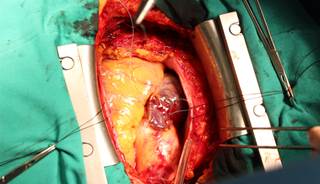 Coronary artery bypass surgery may lead to metabolic changes, causing new-onset diabetes. Coronary artery bypass surgery may lead to metabolic changes, causing new-onset diabetes.