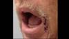 Derm Dx: A lesion on the lip Derm Dx: A lesion on the lip