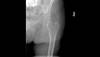 Ortho Dx: Valgus-impacted femoral neck fracture Ortho Dx: Valgus-impacted femoral neck fracture