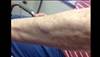 Derm Dx: A nodule on the forearm Derm Dx: A nodule on the forearm