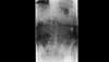 Ortho Dx: Degenerative spondylolisthesis Ortho Dx: Degenerative spondylolisthesis