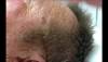 Derm Dx: A hyperkeratotic plaque on the left temple Derm Dx: A hyperkeratotic plaque on the left temple