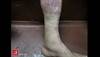 Image of the Week: A fisherman presents with bruising Image of the Week: A fisherman presents with bruising