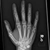 Ortho Dx: Radiolucent lesion on the small finger Ortho Dx: Radiolucent lesion on the small finger