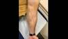 Ortho Dx: Distal biceps rupture Ortho Dx: Distal biceps rupture
