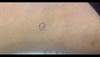 Derm Dx: An asymptomatic papule on the thigh Derm Dx: An asymptomatic papule on the thigh