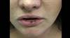 Derm Dx: Dark spots on the lip Derm Dx: Dark spots on the lip