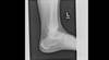 Ortho Dx: Heel pain that worsened after a walking tour Ortho Dx: Heel pain that worsened after a walking tour