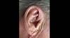 Derm Dx: Painful lesion of the ear Derm Dx: Painful lesion of the ear