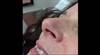 Derm Dx: Asymptomatic growth on nose Derm Dx: Asymptomatic growth on nose