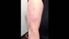 Derm Dx: Recurring rash after sun exposure Derm Dx: Recurring rash after sun exposure
