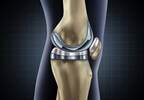 Oxycodone/naloxone may be beneficial for managing pain after total knee replacement Oxycodone/naloxone may be beneficial for managing pain after total knee replacement