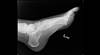 Ortho Dx: The kind of fracture you can't miss Ortho Dx: The kind of fracture you can't miss