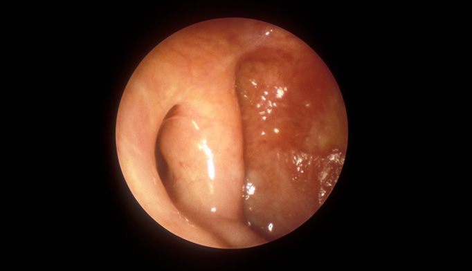 Stat consult: Allergic rhinits - The Clinical Advisor