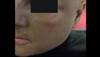 Derm Dx: Striking pigmentation on a former chemical plant worker Derm Dx: Striking pigmentation on a former chemical plant worker