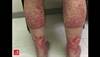 Image of the Week: Pedaling purpura Image of the Week: Pedaling purpura