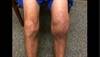 Ortho Dx: Stiffness after total knee replacement Ortho Dx: Stiffness after total knee replacement