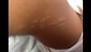 Derm Dx: Linear dermatosis that follows the lines of Blaschko Derm Dx: Linear dermatosis that follows the lines of Blaschko